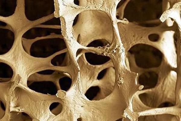 osteoporosis-disparara-costos-por-fracturas